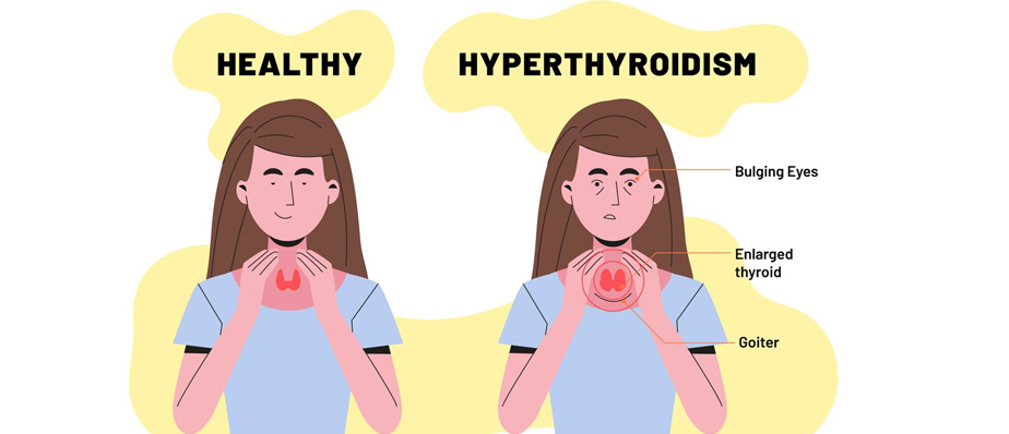 Hospitals and clinics in Thane | Hyperthyroidism 